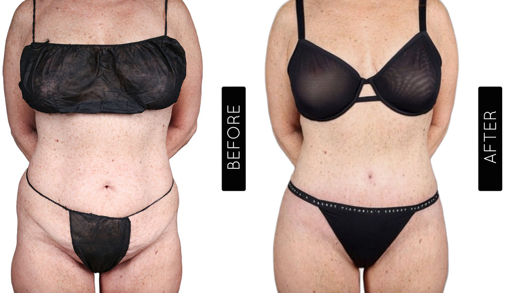 Tummy Tuck Before and After