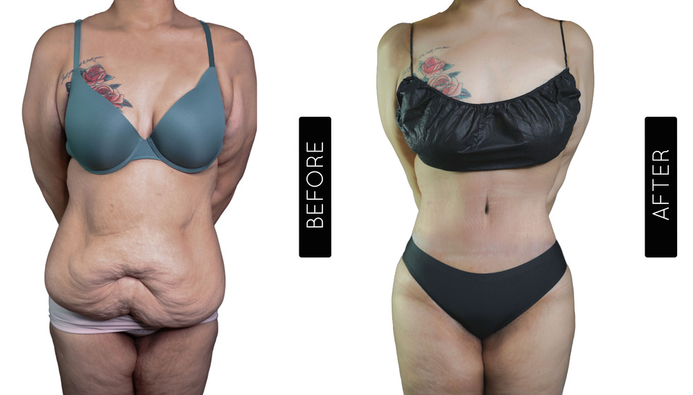 Tummy Tuck Before and After