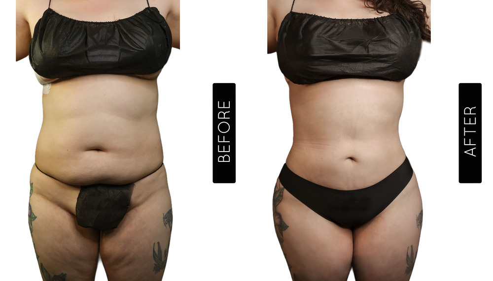 Tummy Tuck Before and After