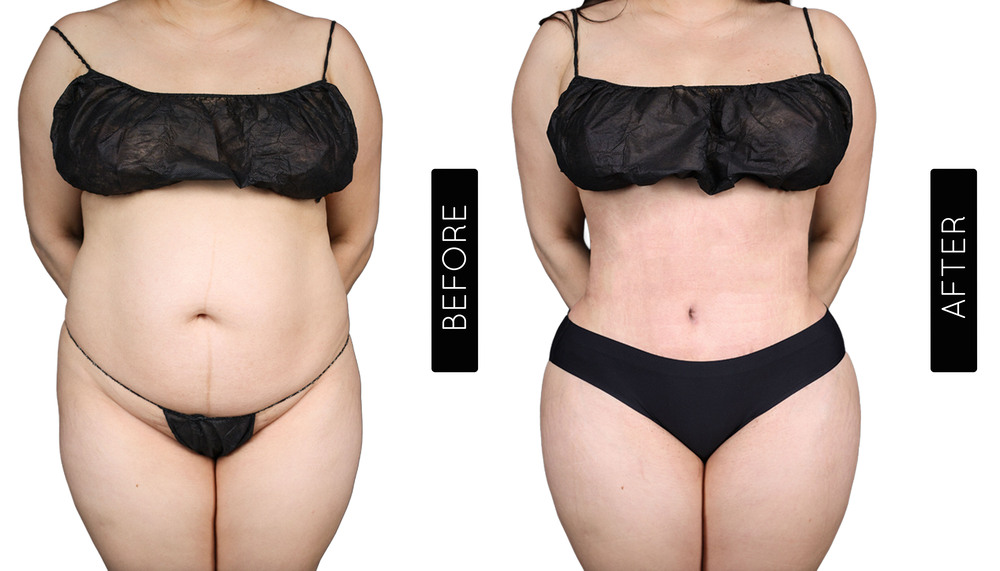 Tummy Tuck Before and After