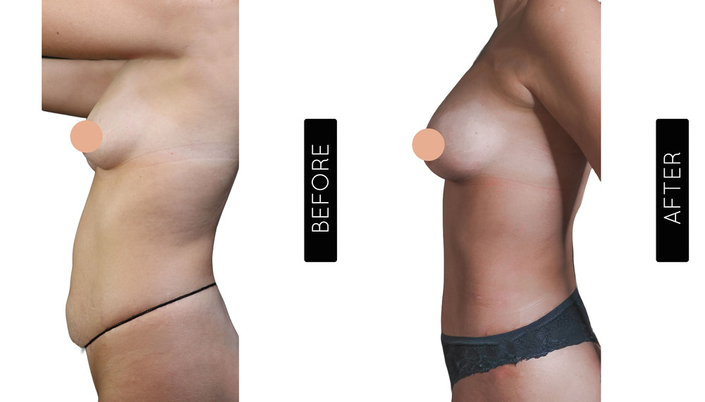 Mini Tummy Tuck Before and After