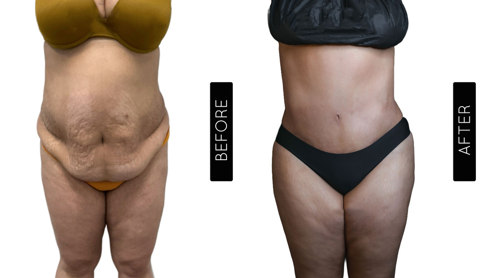 Tummy Tuck Before and After