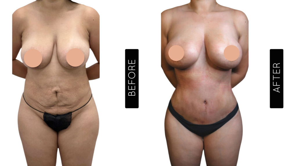 Tummy Tuck Before and After