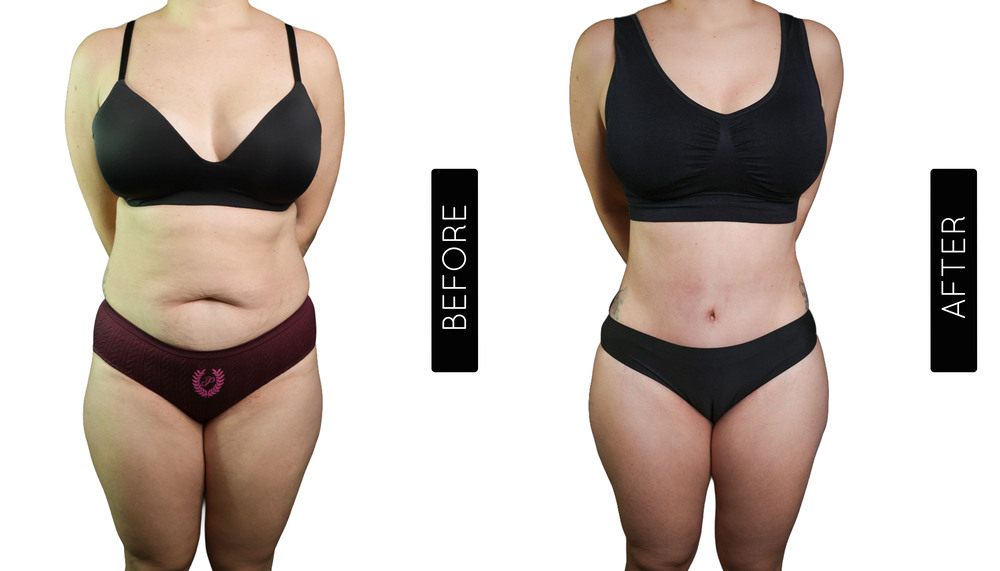 Tummy Tuck Before and After