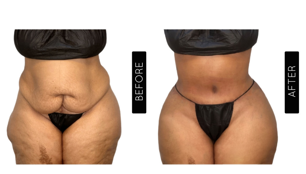 Tummy Tuck Before and After
