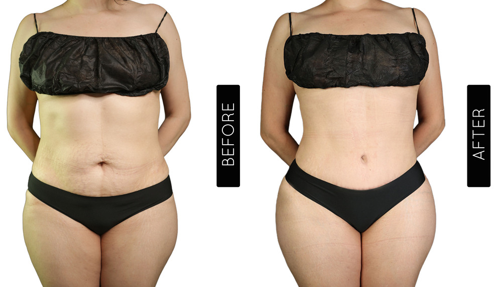 Tummy Tuck Before and After