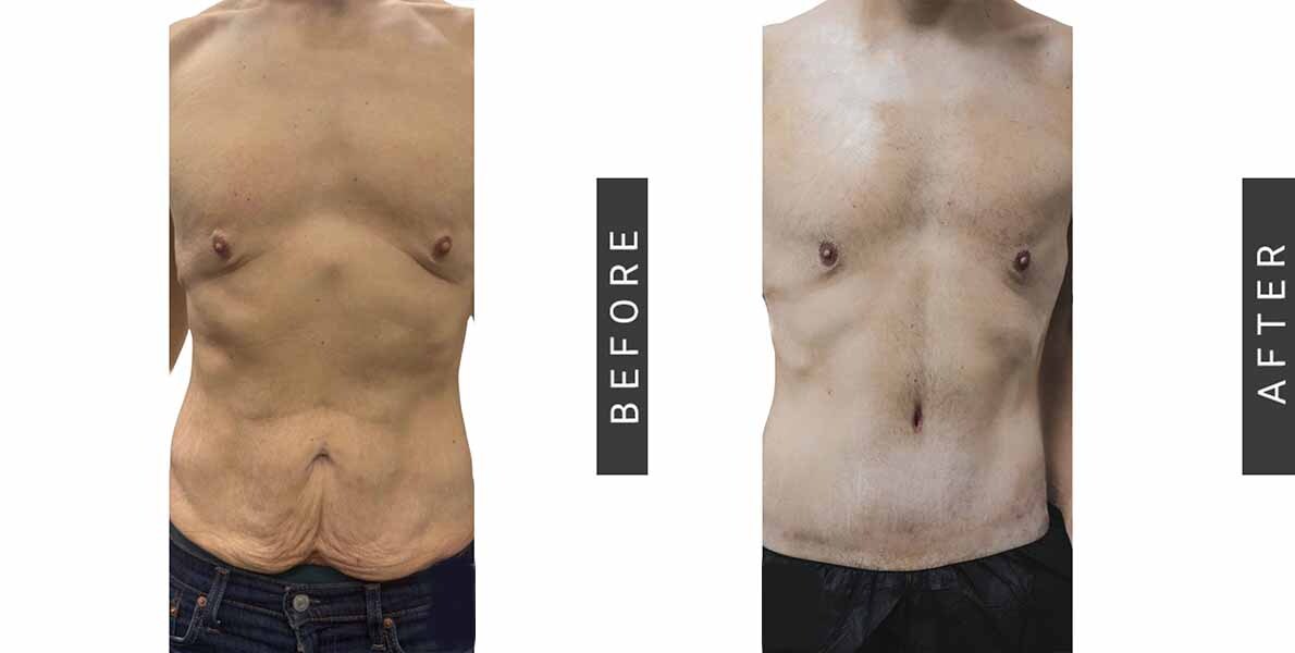 Male Tummy Tuck Before & After
