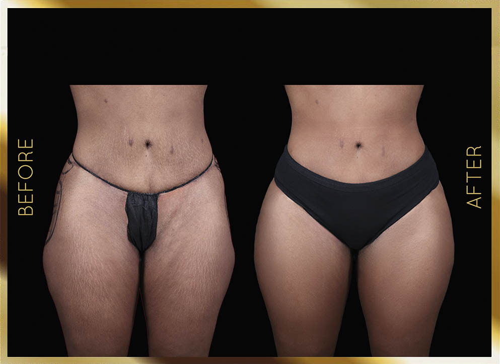 AlloClae Filler Before & After NYC Case-1