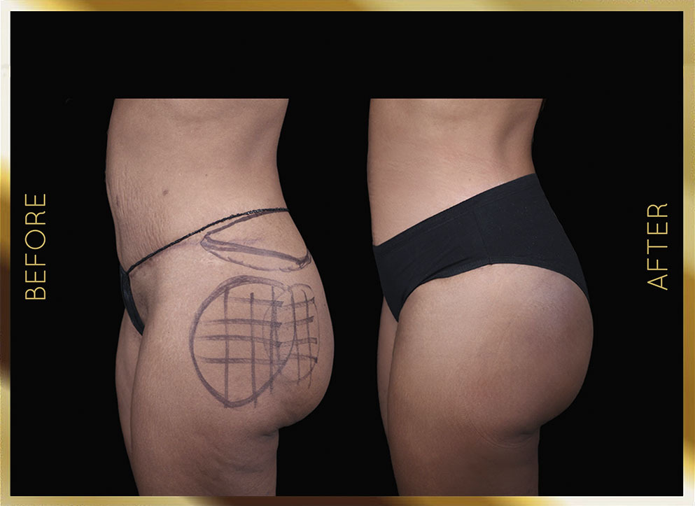 AlloClae Filler Before & After NYC Case-2