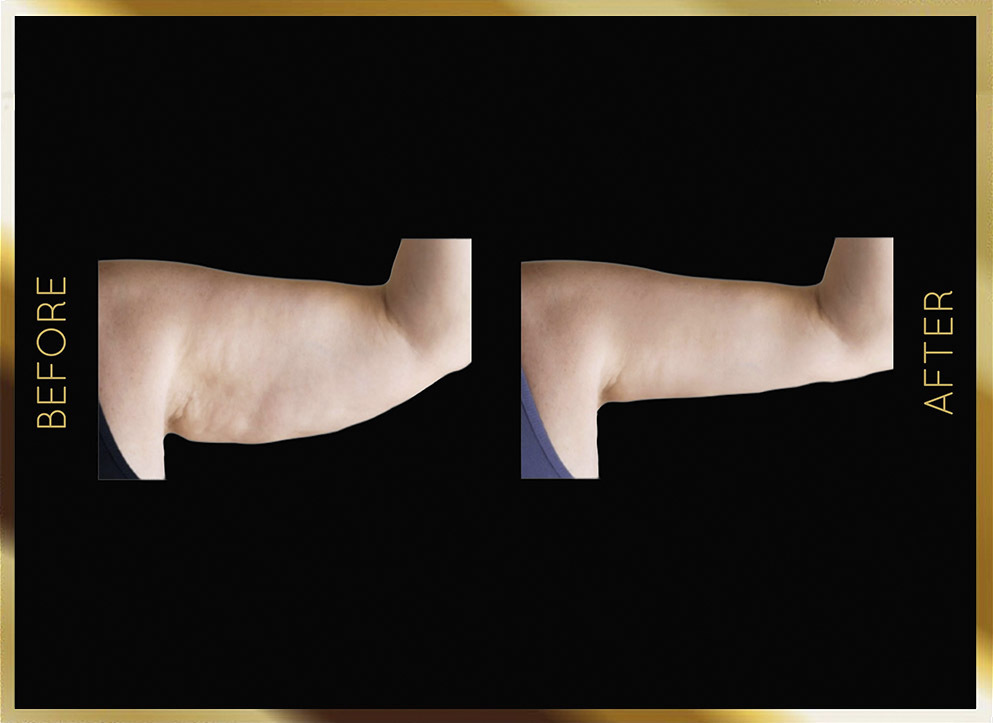 Antes y después de una cirugía de lifting de brazos en Nueva York - Caso 4