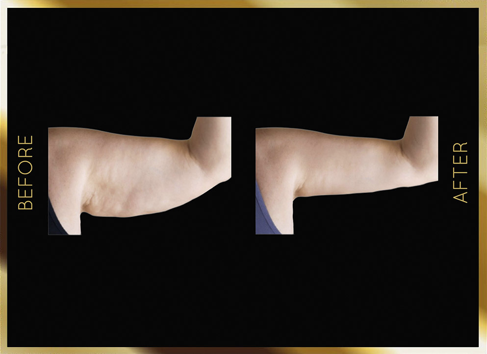 Arm Liposuction Before & After NYC Case-2