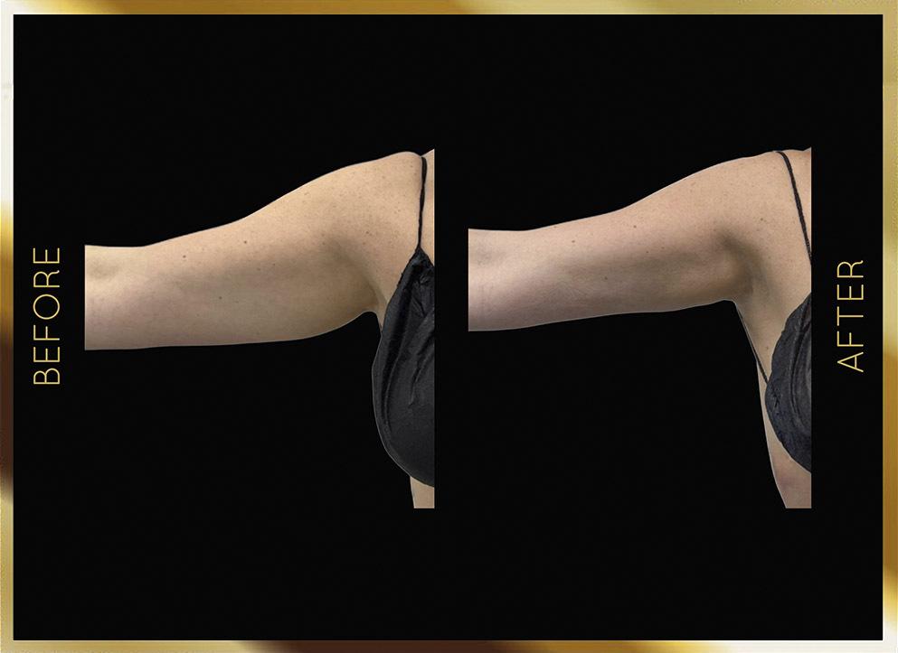 Arm Liposuction Before & After NYC Case-3