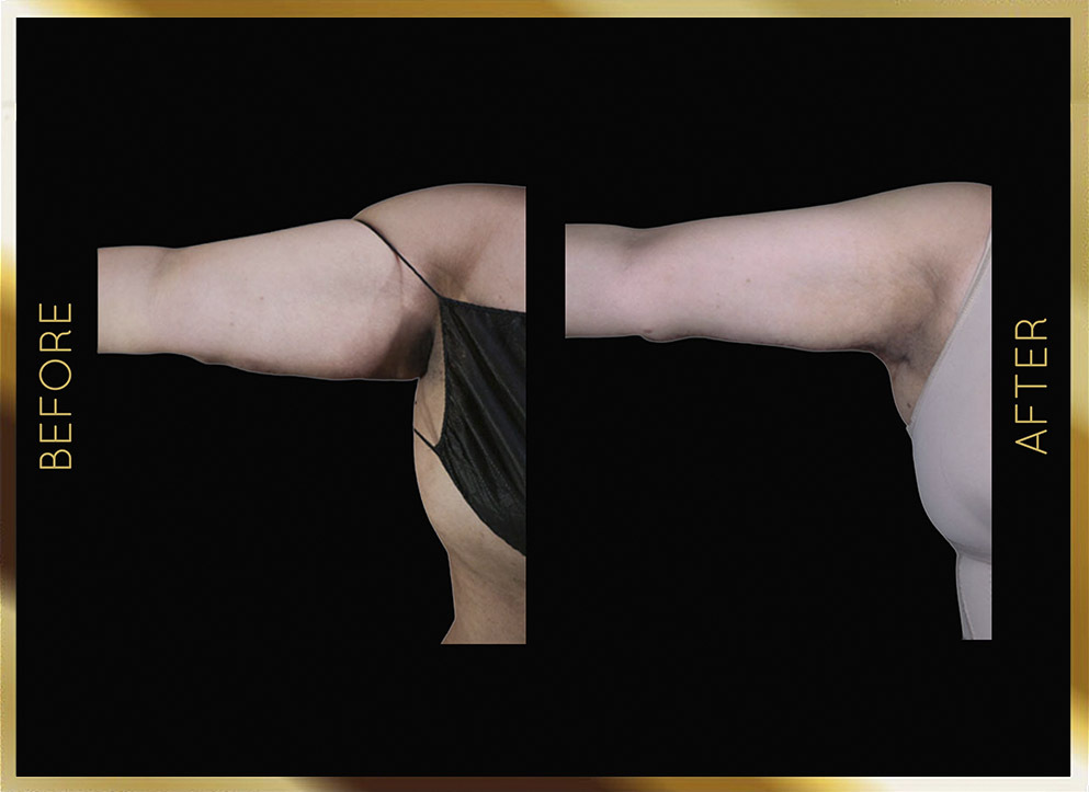 Arm Liposuction Before & After NYC Case-4