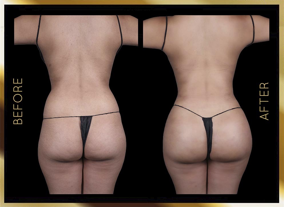 Back Liposuction Before & After NYC Case-1