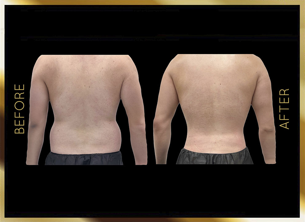 Back Liposuction Before & After NYC Case-3