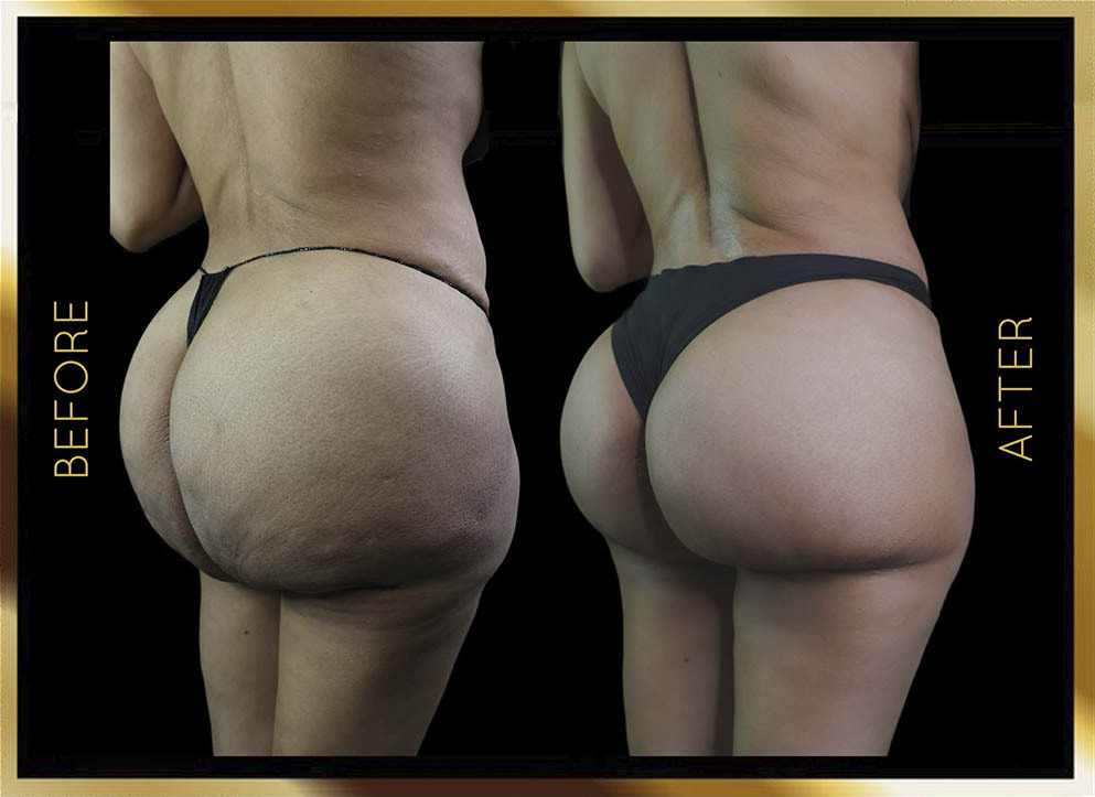 Biopolymer Removal Before and After NYC Case-2 Side