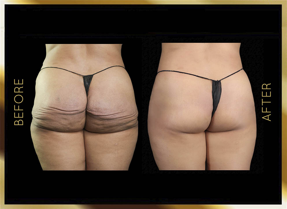 Biopolymer Removal Before and After NYC Case-3 Front