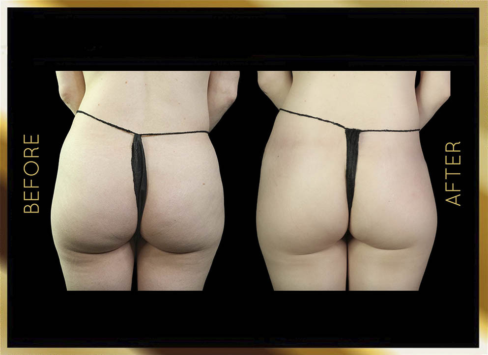 Biopolymer Removal Before and After NYC Case-4 Front