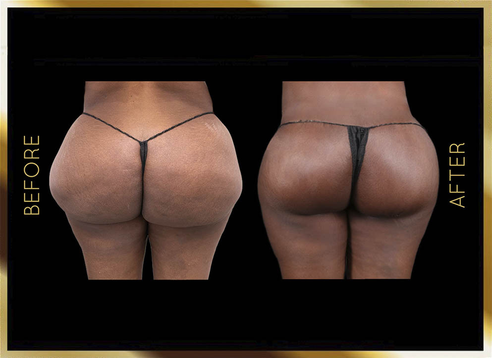 Biopolymer Removal Before and After NYC Case-5 Front