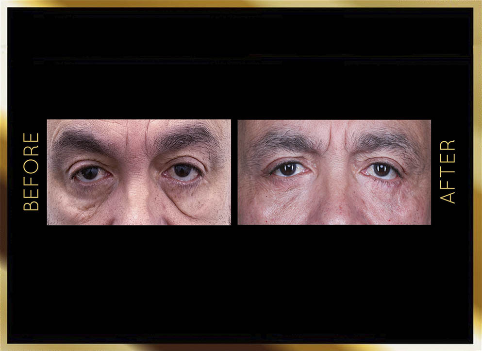 Blefaroplastia: antes y después en Nueva York - Caso 1: vista frontal