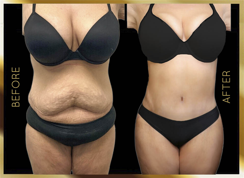 Lifting corporal: antes y después. Caso 1 en Nueva York: vista frontal