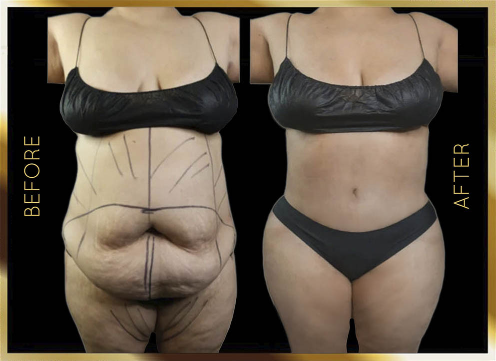 Lifting corporal: antes y después, Nueva York, caso 3 (vista frontal)