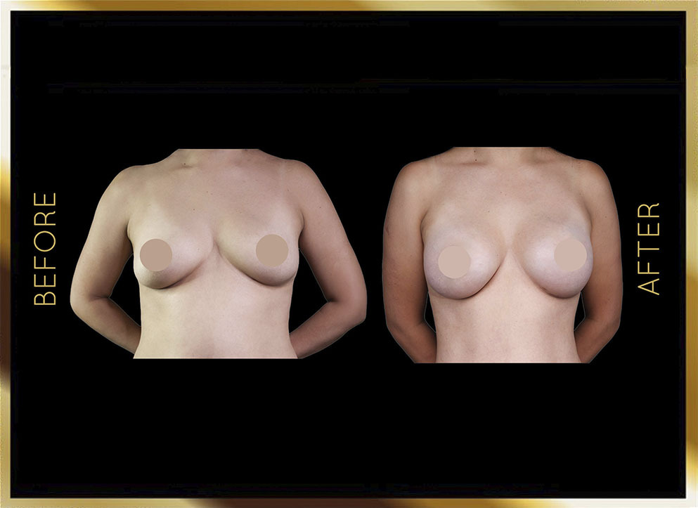 Breast Augmentation Before and After NYC Case-5 Front