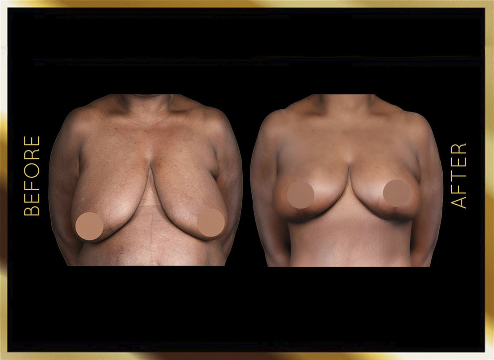 Breast Reduction Before and After NYC Case-2 Front