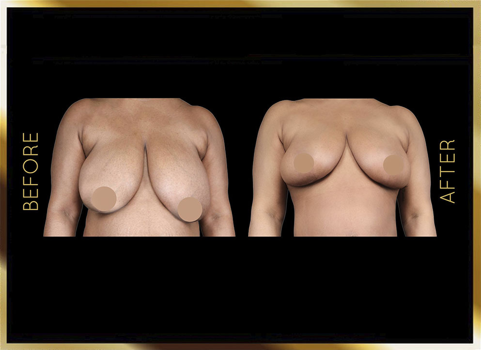 Breast Reduction Before and After NYC Case-3 Front