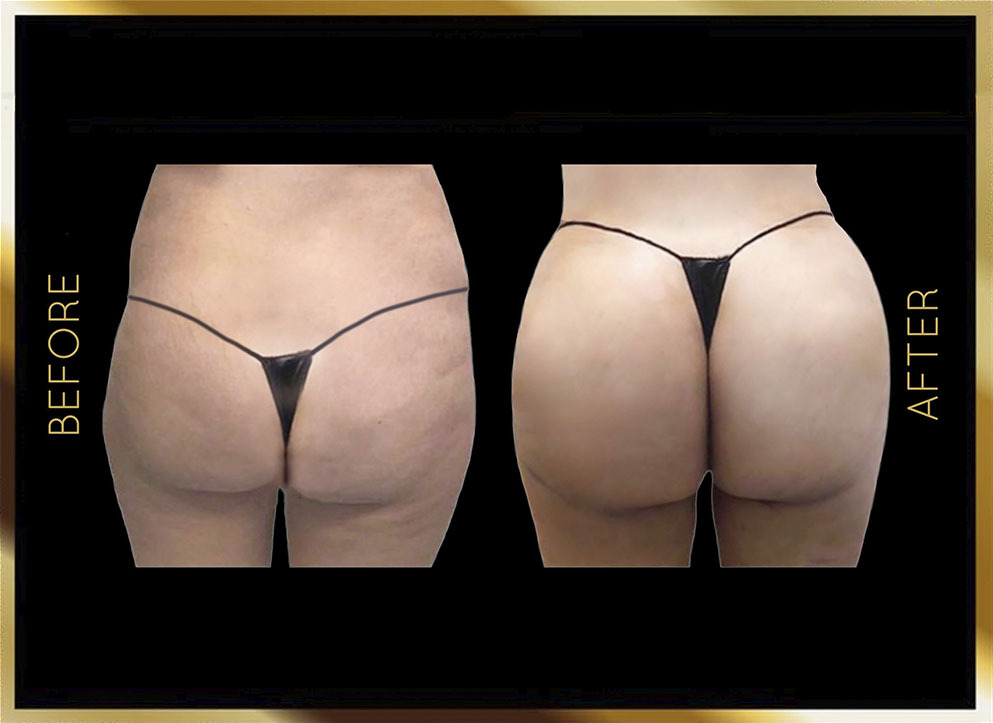 Butt Reduction Before and After NYC Case-1 Front