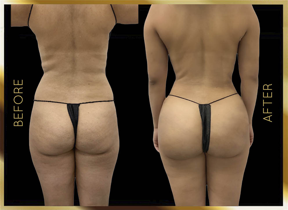 Butt Reduction Before and After NYC Case-10 Front