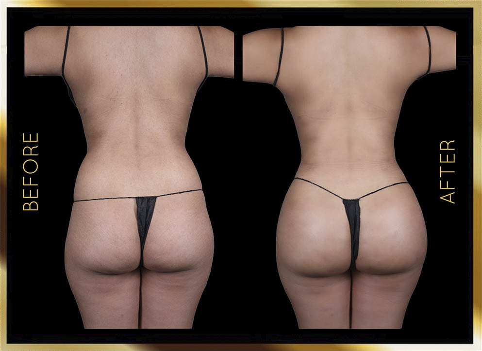Butt Reduction Before and After NYC Case-11 Front