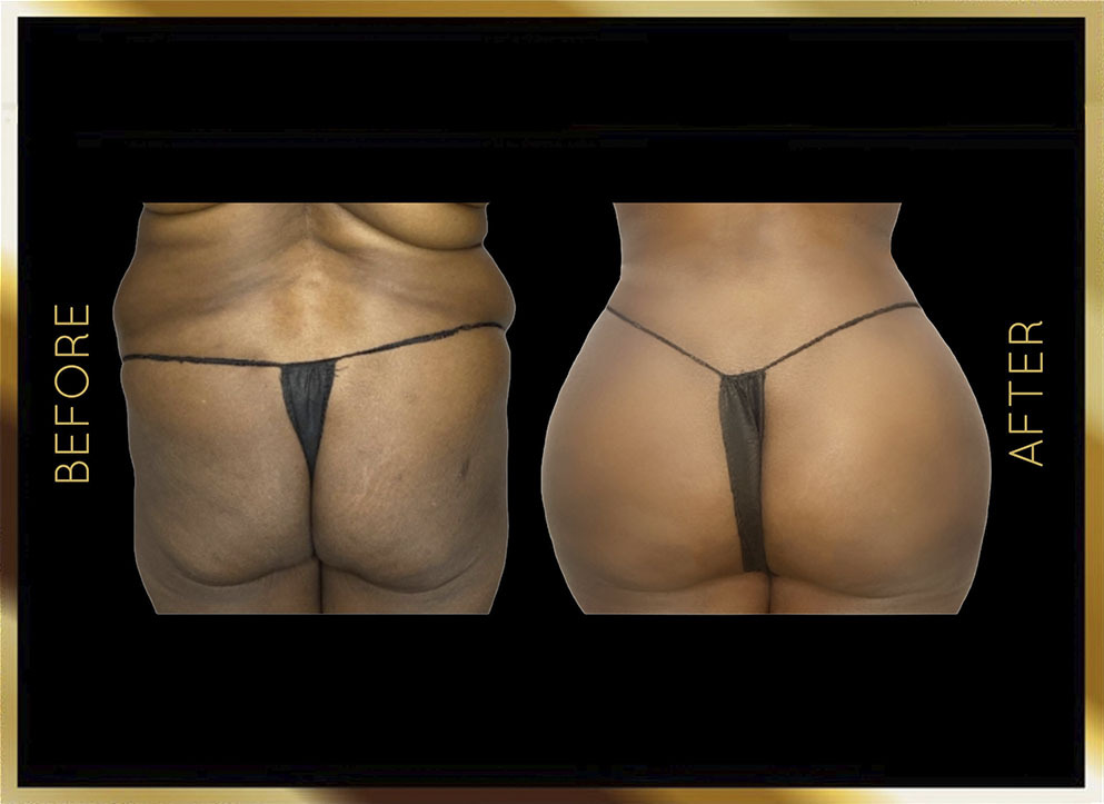 Butt Reduction Before and After NYC Case-2 Front
