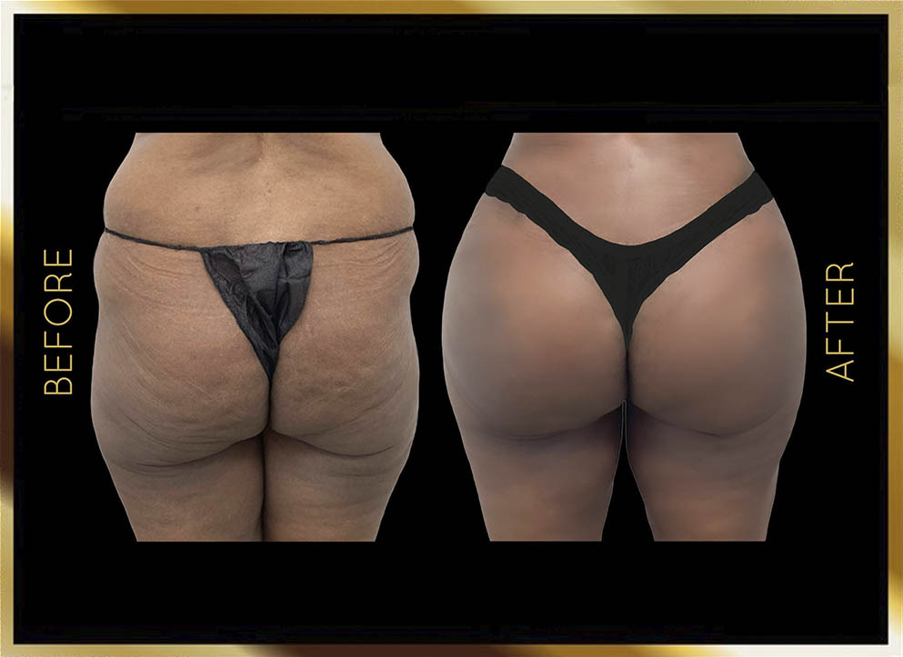 Butt Reduction Before and After NYC Case-3 Front