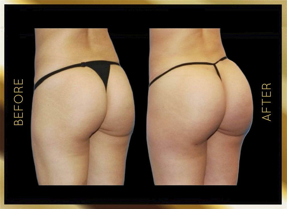 Butt Reduction Before and After NYC Case-4 Side