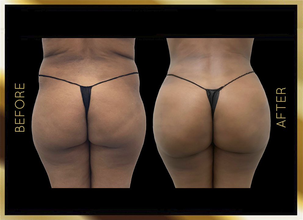 Butt Reduction Before and After NYC Case-5 Front