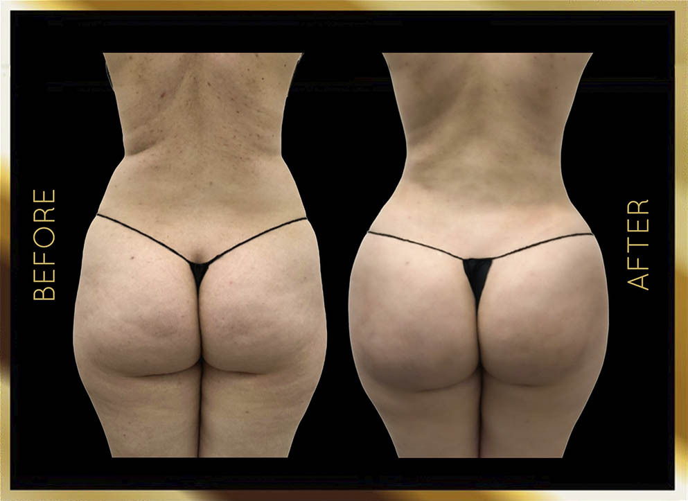Butt Reduction Before and After NYC Case-7 Front