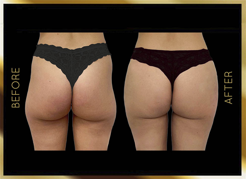 Butt Reduction Before and After NYC Case-8 Front