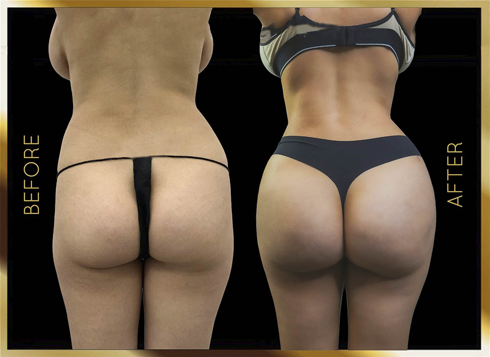 Butt Reduction Before and After NYC Case-9 Front