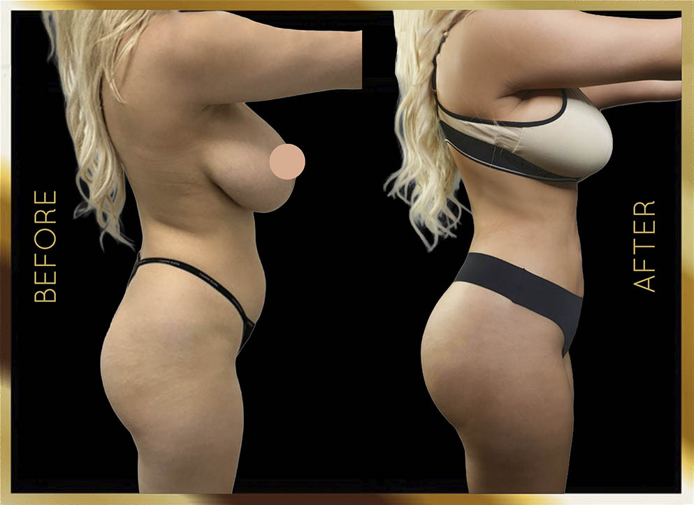 Butt Reduction Before and After NYC Case-9 Side