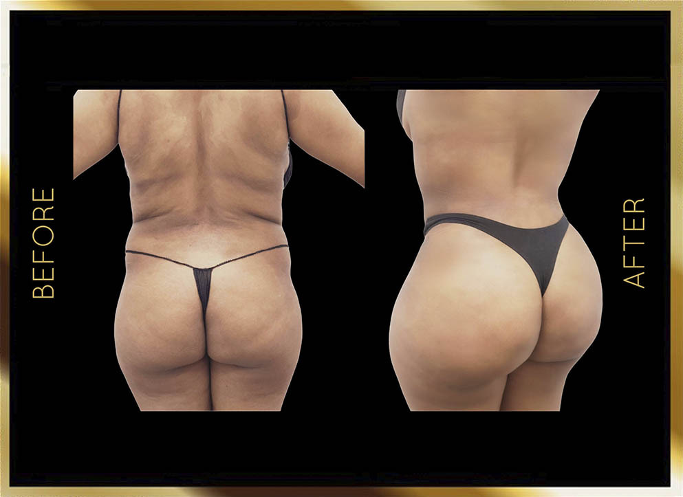 Buttock Lift Before and After NYC Case-6 Side