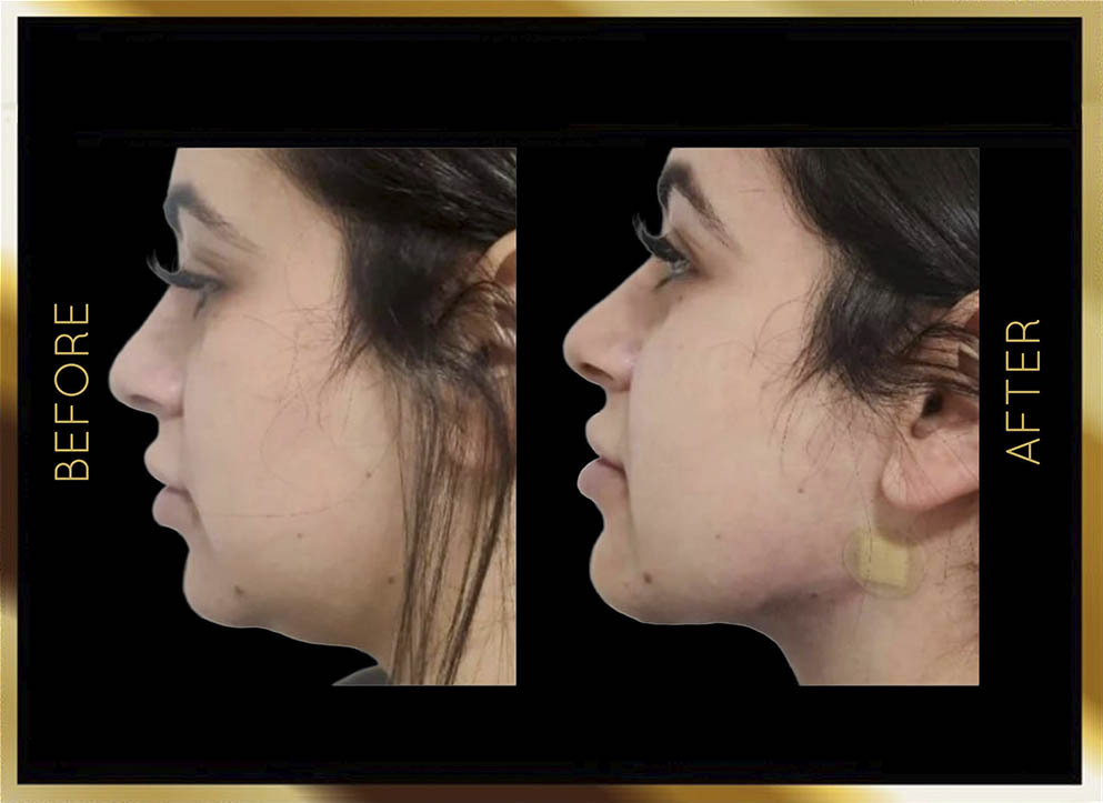 Chin Lipo Before and After NYC Case-4