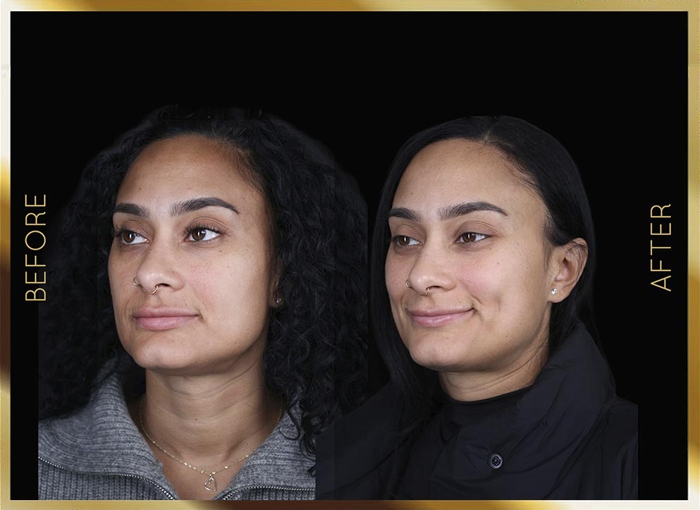 Dimpleplasty Before and After NYC Case-1
