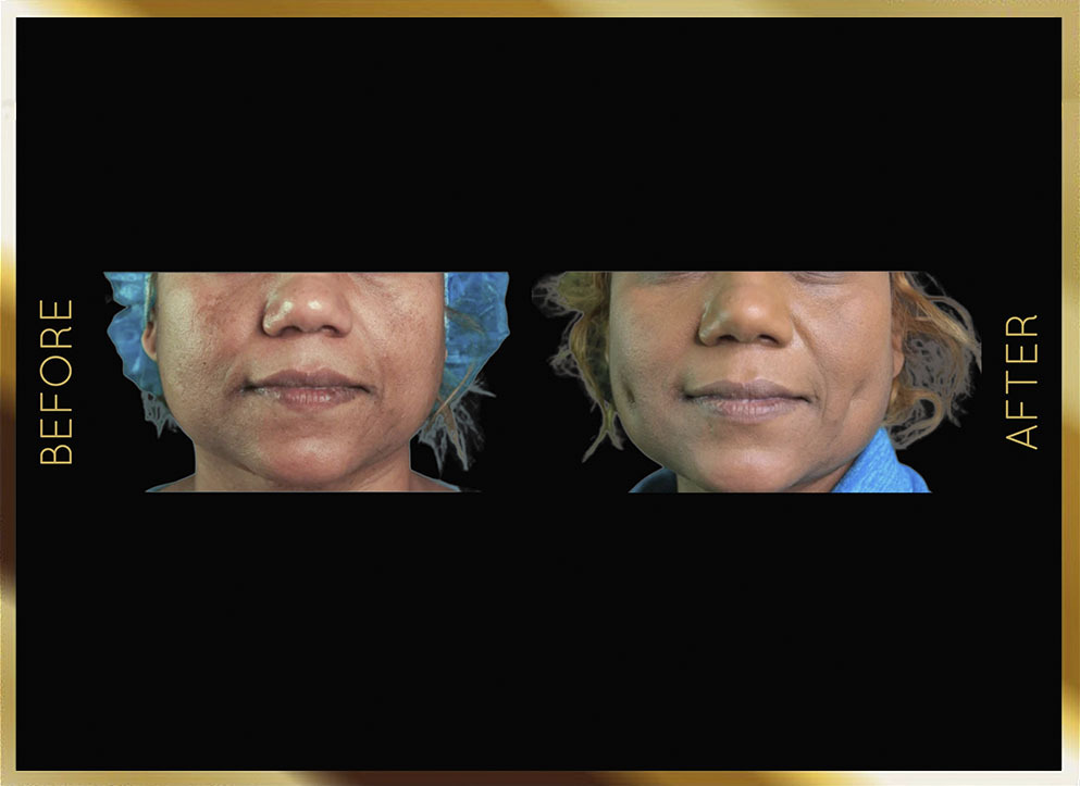 Dimpleplasty Before and After NYC Case-2