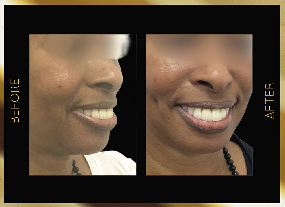 Dimpleplasty Before and After NYC Case-3