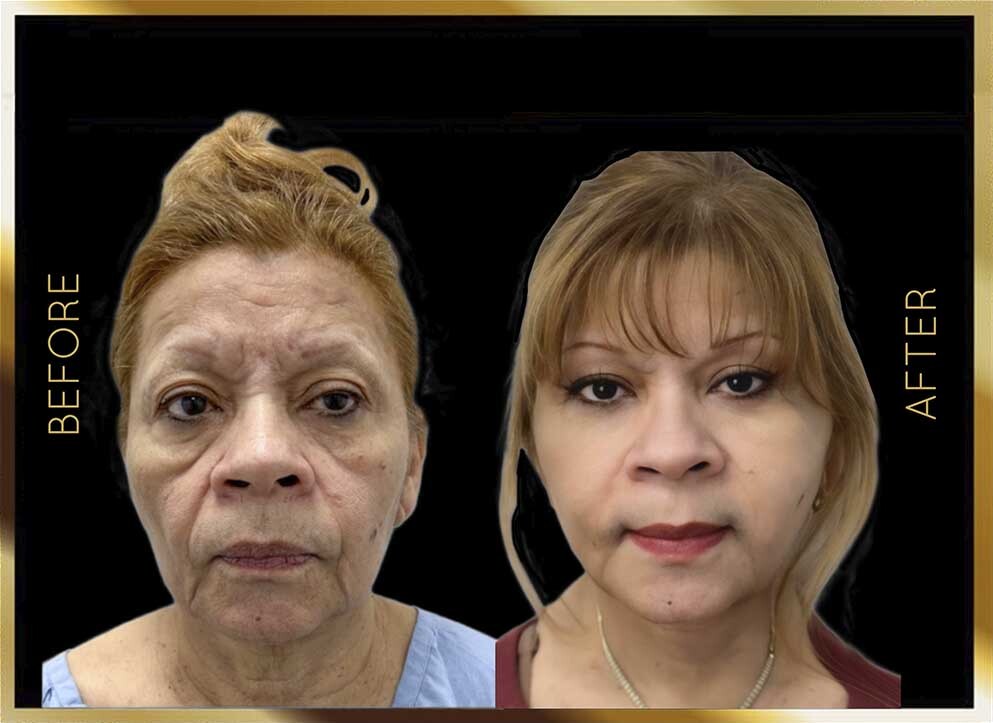 Cirugía de papada: antes y después. Caso 4, Nueva York. Vista frontal