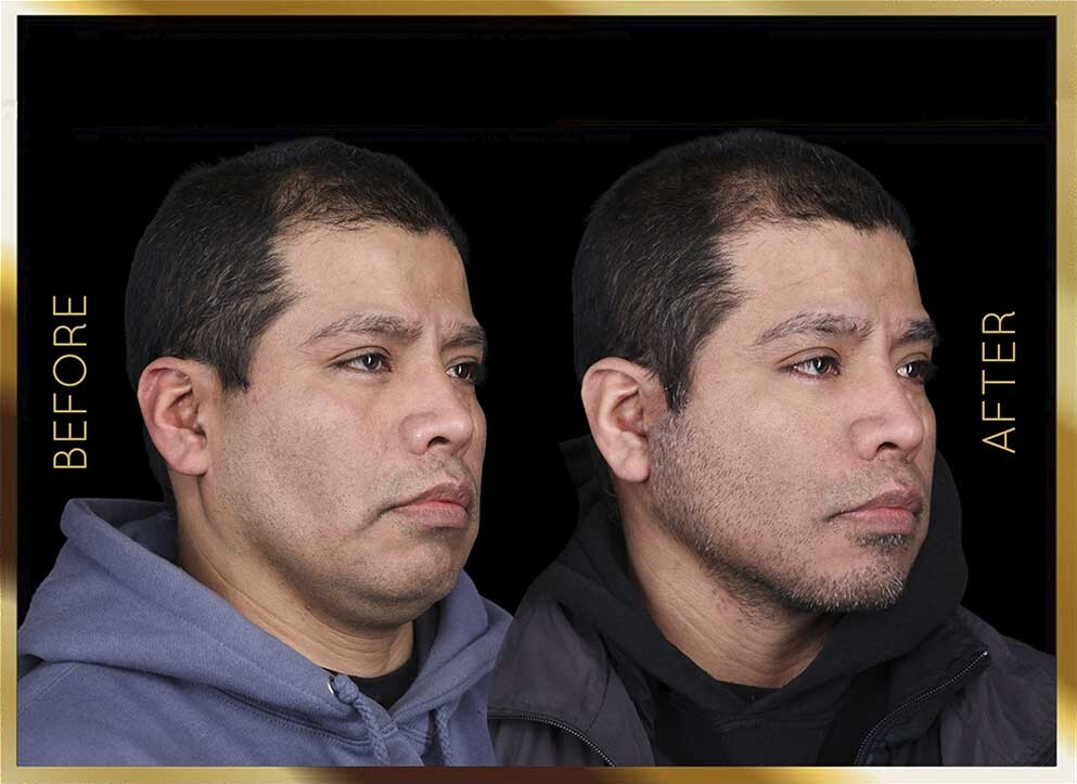 Cirugía de papada: antes y después. Caso n.º 5 en Nueva York (vista lateral)