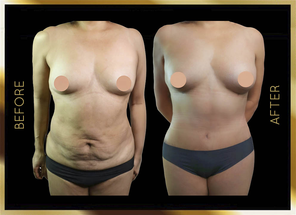 Extended Tummy Tuck Before and After NYC Case-2 Front