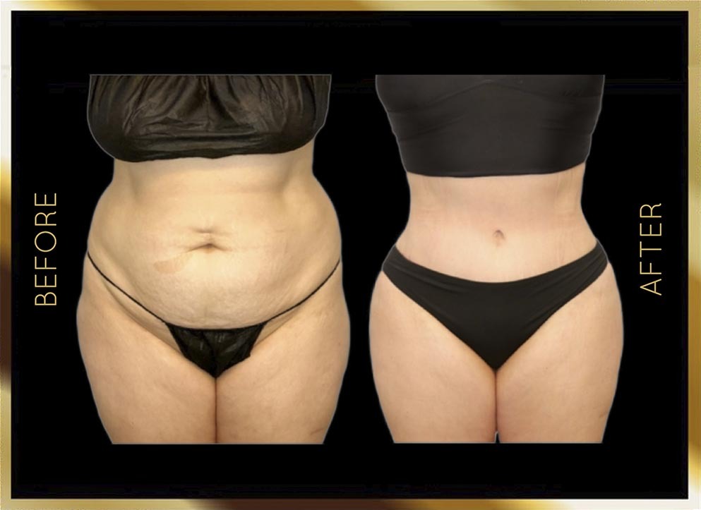 Extended Tummy Tuck Before and After NYC Case-4 Front