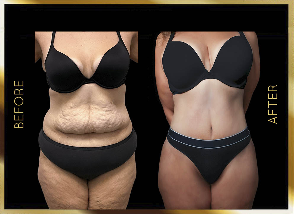 Extended Tummy Tuck Before and After NYC Case-5 Front